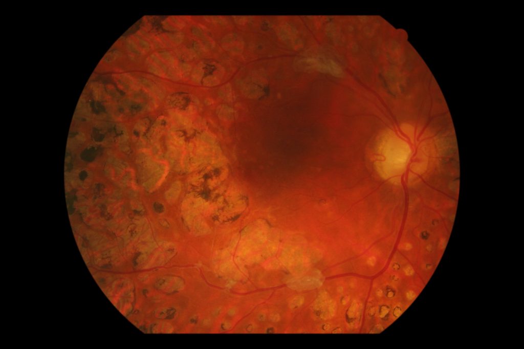 Diabetic retinal laser scars